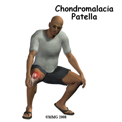 Chondromalacia Patella Patient Guide