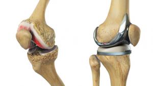 Joint Replacement Physiotherapy